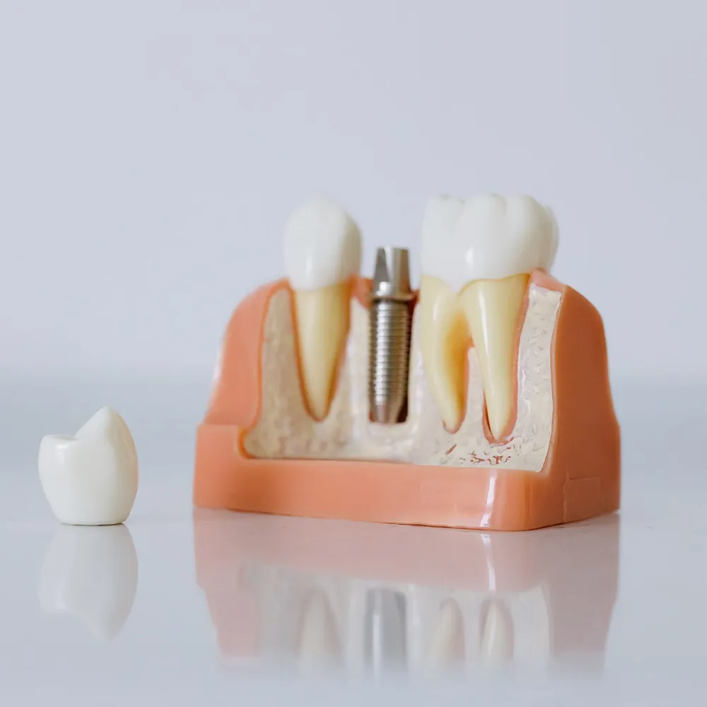 Un modelo que muestra cómo va colocado un implante dental